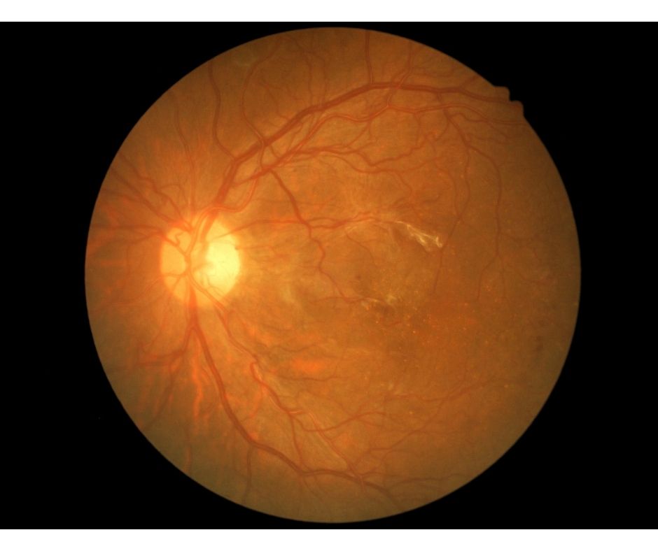 diabetic-retinopathy-mysugarwatch